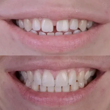 ВІНІРИ БАГАТО