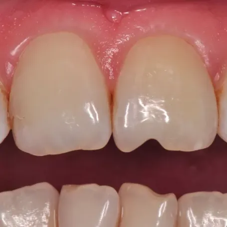 Клінічний випадок із використанням гібридного композиту з ультрадрібними частками наповнювача Essentia.