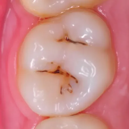 Клінічний випадок з EQUIA Forte