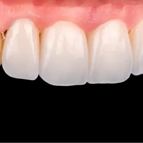 Клінічний випадок від техніка-демонстратора GC Ukraine Павла Мілованова