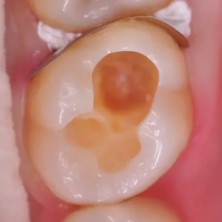 Клінічний випадок з EQUIA Forte