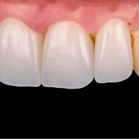 Клінічний випадок від техніка-демонстратора GC Ukraine Павла Мілованова