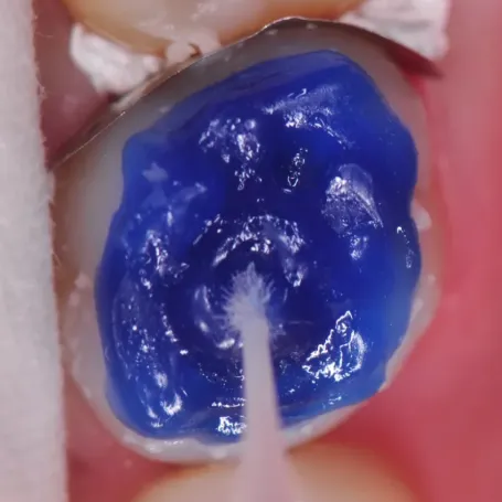 Клінічний випадок з EQUIA Forte