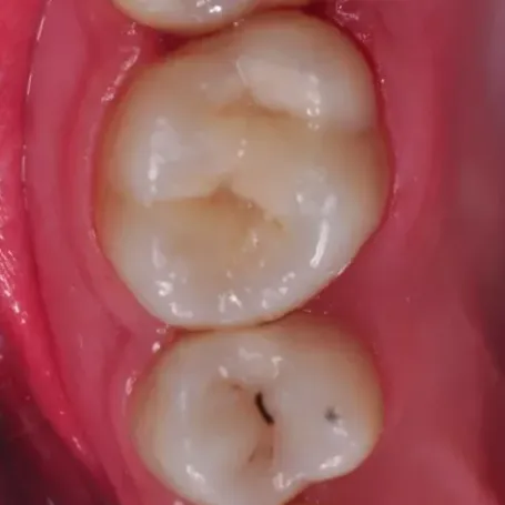 Клінічний випадок з EQUIA Forte