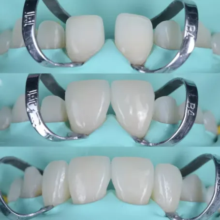 Клінічний випадок естетичного відновлення твердих тканин зуба вінірами