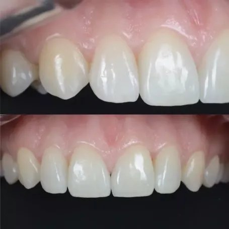 Клінічний випадок естетичного відновлення твердих тканин зуба вінірами
