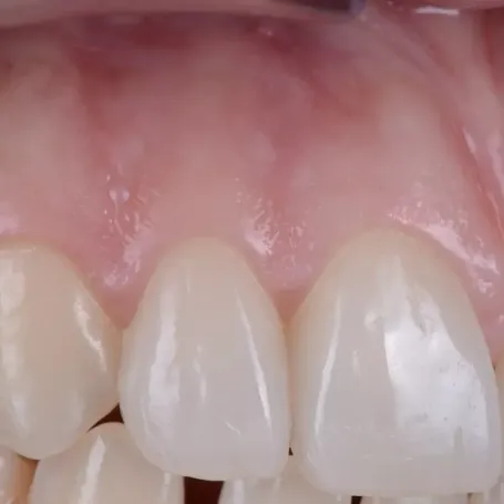 Клінічний випадок естетичного відновлення твердих тканин зуба вінірами
